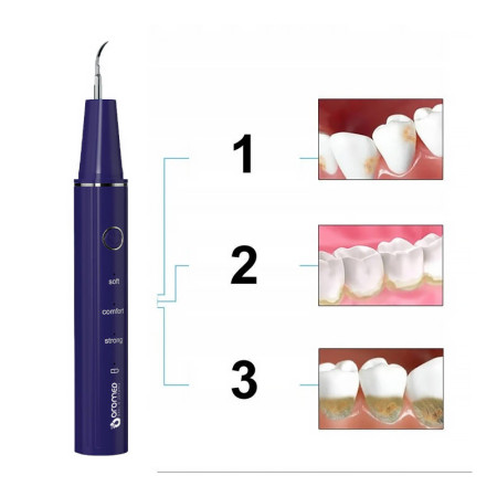 Ultrazvukový odstraňovač zubného kameňa OROMED ORO-SCAL DENT
